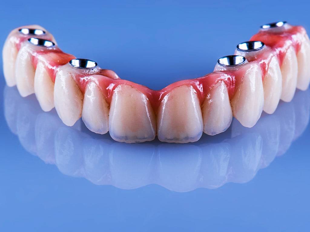 Implant Dentaire Tunisie