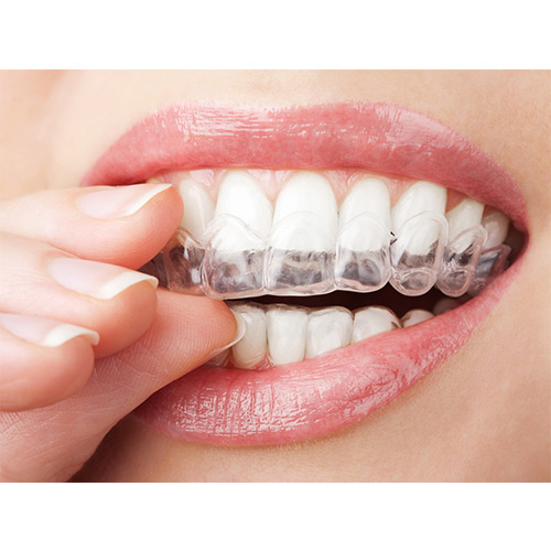 Blanchiment dentaire Tunisie : des dents blanches en une séance