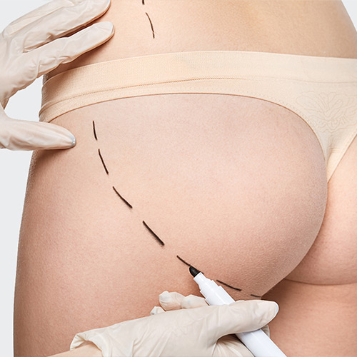 Le Bodylift Tunisie : lipectomie circulaire