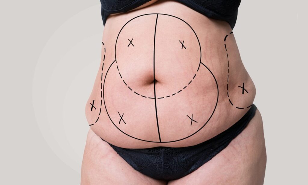 Tummy Tuck Tunisie Meilleur prix