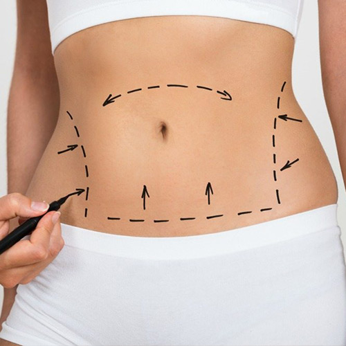 Tummy Tuck : liposuccion & abdominoplastie