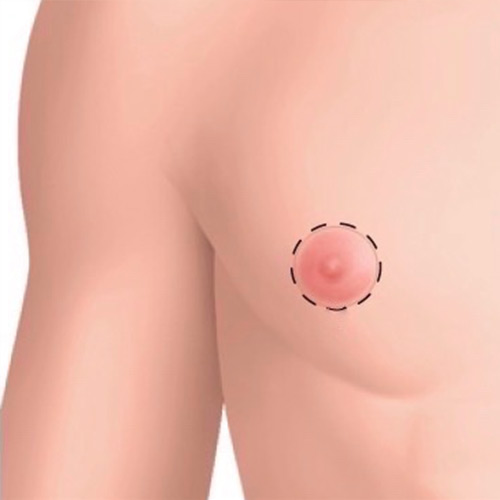 Gynecomastie Tunisie : pour corriger l’excès de la glande mammaire masculine